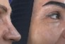 کاشت مو و ابرو با پرداخت 8 تومن و قسطی